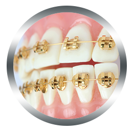 evernew-gold-brackets